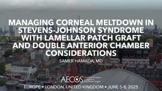 46 - -Managing Corneal Meltdown in Stevens-Johnson Syndrome with Lamellar -Patch Graft and Double Anterior Chamber Consideration [1105878298].mp4